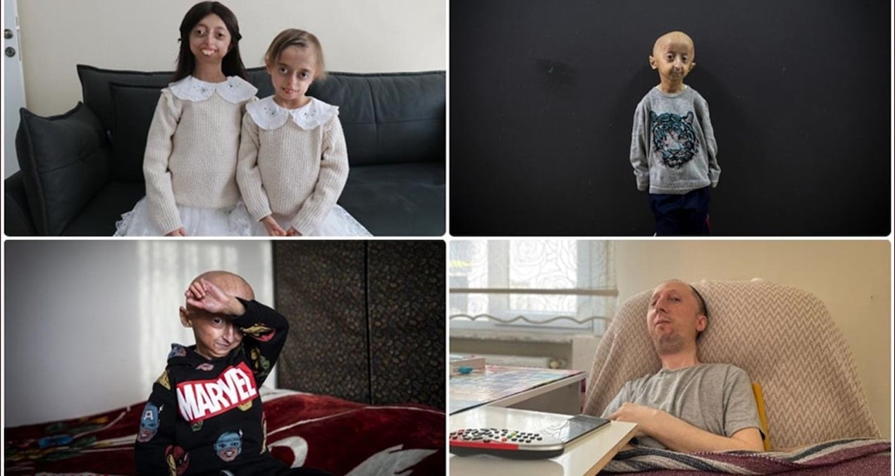 400 milyon kişiyi etkileyen nadir hastalıklar: İşte en ilginç vakalar